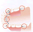 部分入れ歯