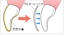 ラミネートベニア