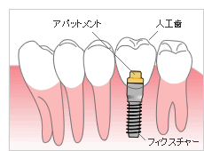 インプラント